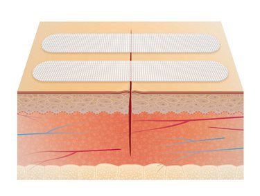 Leukosan Sterile Wound Closure Strips (Assorted Pack of 9)