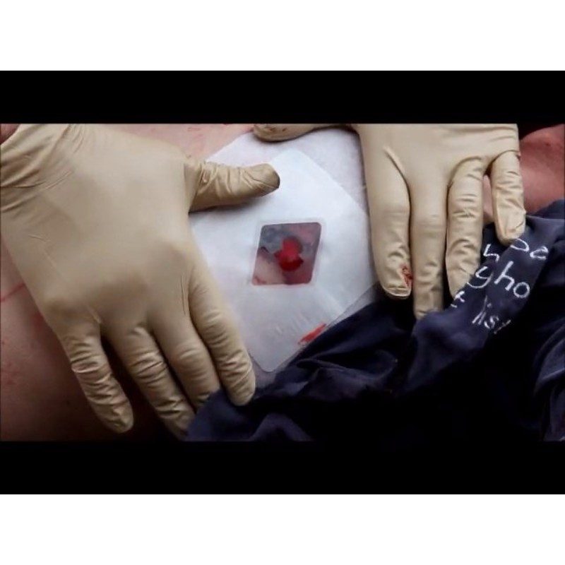 Prometheus Russell Chest Seal for open pneumothorax